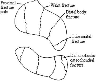 Fractures of the scaphoid referat