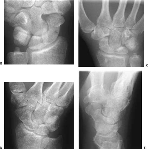 80 Scaphoid Fractures Radiology Key