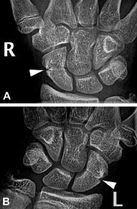 Ap Radiographs Of The Carpal Bones At The Time Of Injury A
