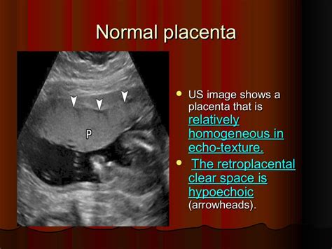 Placenta Ultrasound