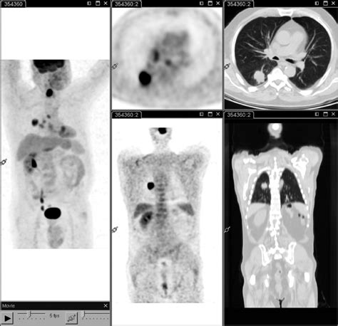 18f Fdg Pet Ct Performed At Staging In A Patient With Laryngeal