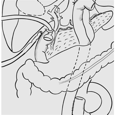Diagram Of Reconstruction After Emergency Gastrectomy In Which The
