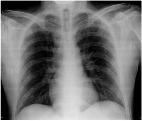 Normal Preoperative Anteroposterior Chest Radiograph Download