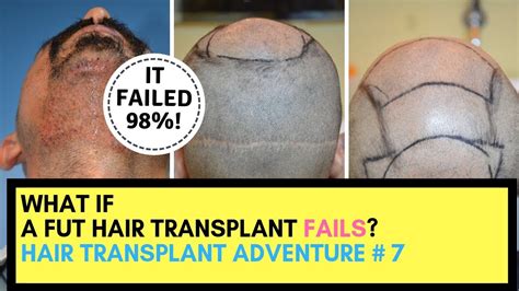 Failed Hair Transplant Revision And Its Side Effects Youtube