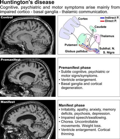 This defect is dominant, meaning that anyone who inherits it from a parent with huntington's will eventually develop the disease. Imaging and clinical manifestations of Huntington's ...