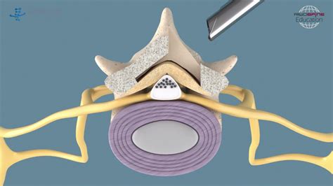 Spinal Stenosis Full Endoscopic Decompression At The Lumbar Spine With Vertebris Stenosis