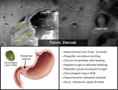 Pyloric Stenosis Upper Gi Series
