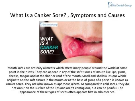 Tablo Read Canker Sores Symptoms Causes And Treatment By Images