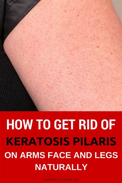 Discover How To Get Rid Of Keratosis Pilaris Kp Known Colloquially As