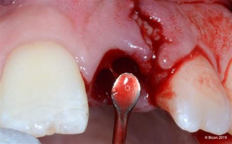 5 Uso De Una Cureta Para Raspar Y Evaluar El Hueso Alveolar Dental Tonal