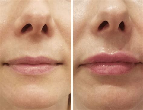 The Botox Lip Flip Achieve A Fuller Looking Pout Orange County