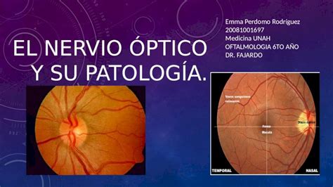 PPTX El nervio óptico y su patología DOKUMEN TIPS