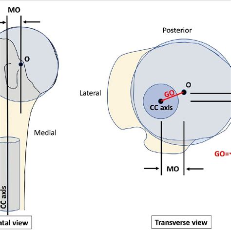 Determination Of The Medial And Posterior Components Of Humeral Head