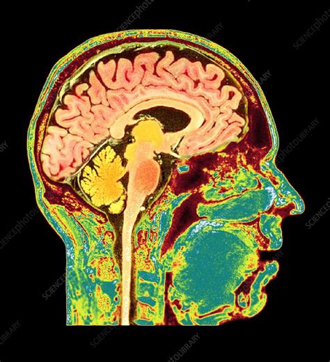 Normal Human Brain Mri Scan Stock Image C0168850 Science Photo
