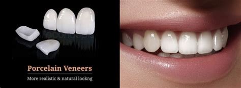 Everything You Need To Know About Porcelain Veneers
