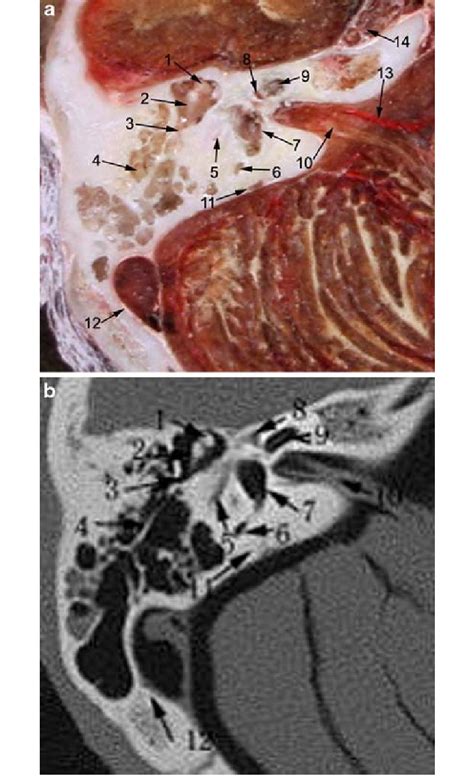A Section Of The Malleoincudal Articulation B Ct Corresponding To A 1