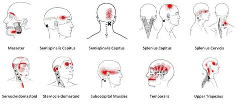 One Sided Trapezius Headache Headache