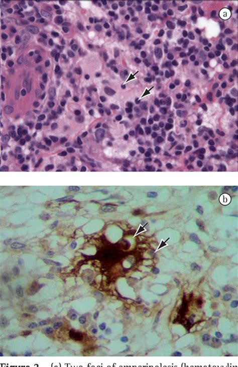 Figure 2 From Soft Tissue Rosai Dorfman Disease Of The Posterior