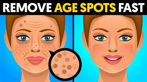 The Quickest Way To Remove Age Spots Youtube