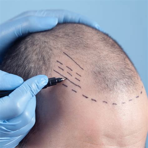 Hair Transplant Treatments In Mumbai Types Results And Cost