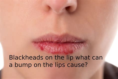 Blackheads On The Lip What Can A Bump On The Lips Cause