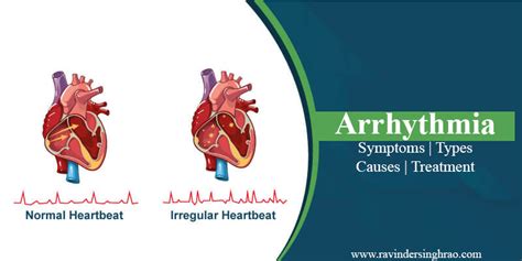 Heart Arrhythmia Types Symptoms Causes Treatment