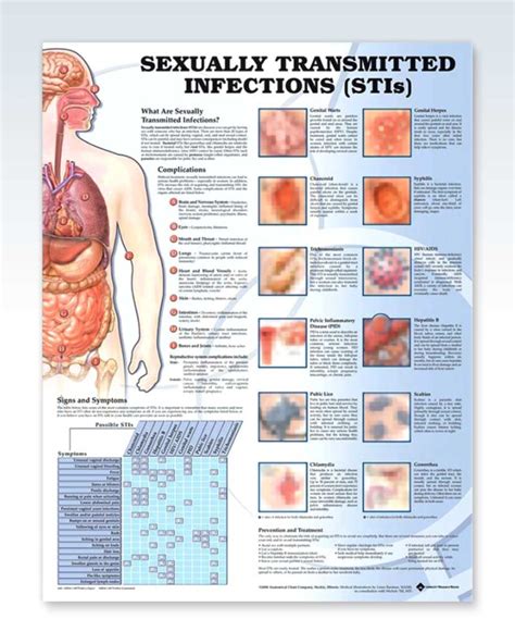 Sexually Transmitted Infections Exam Room Anatomy Poster Clinicalposters