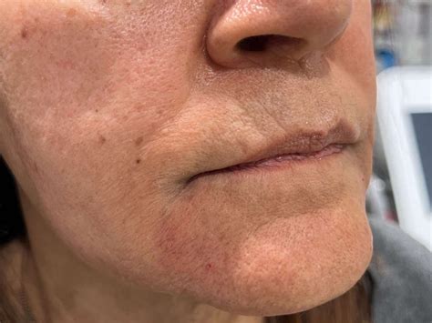 before and afternasolabial folds doll lines and lips — cpw vein and aesthetic center