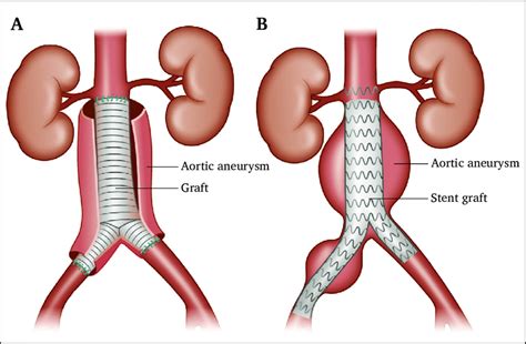 2 A Open Surgery For An Abdominal Aortic Aneurysm Open Aaa Repair