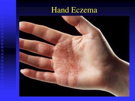 Ppt Atopic Dermatitis Powerpoint Presentation Free Download Id782987