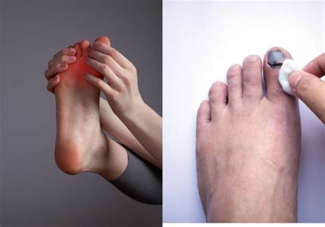 Sprained Big Toe Vs Broken Big Toe How To Tell The Difference And What