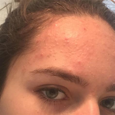 Hundreds Of Forehead Bumps I Can T Get Rue Of General Acne Discussion Forum