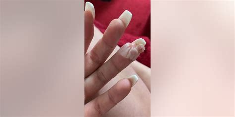 Woman Claims Botched Acrylic Nail Job Nearly Cost Her A Finger Ill Never Get My Nails Done