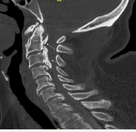 Sagittal Ct Myelogram Demonstrating Opll From C2 5 In The Cervical