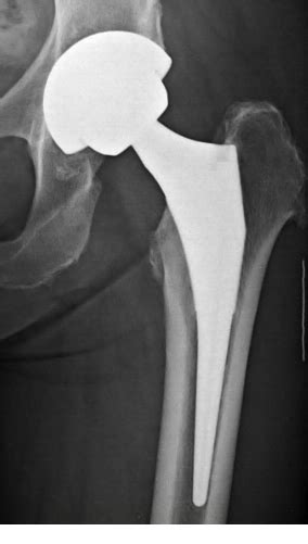 Implant Atlas — Hip And Knee Book