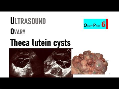 Theca Luteum Cyst