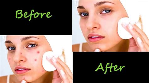 How To Remove Acne Pimple And Make Skin Smooth Editing With Adobe