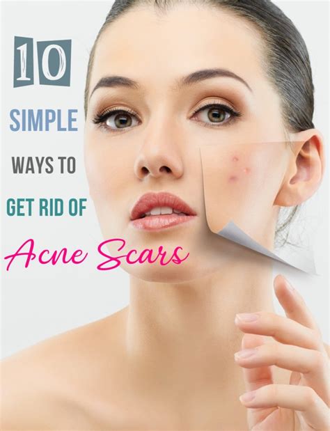 10 Simple Ways To Get Rid Of Acne Scars