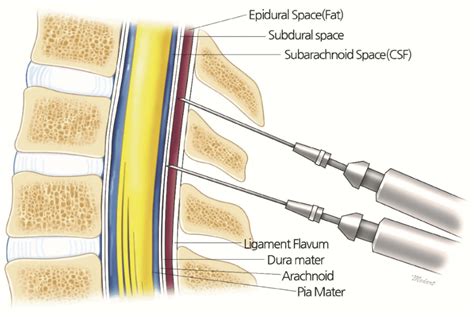 Anatomy Of Epidural Subdural Subarachnoid Space From Outside To Inside