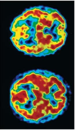 Bipolar bipolar depression people will forget to eat or will become preoccupied with stuff they think is more they can also have the symptoms of mania at the same time. Dementia - body, process, life, system, parts, cause, part
