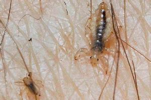 Pubic Lice Causes Symptoms Diangosis And Treatment Natural Health News
