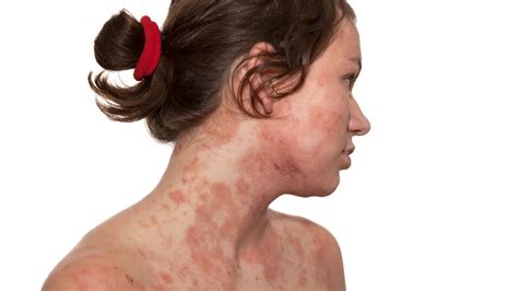 Autoimmune Progesterone Dermatitis Description Causes And Treatment