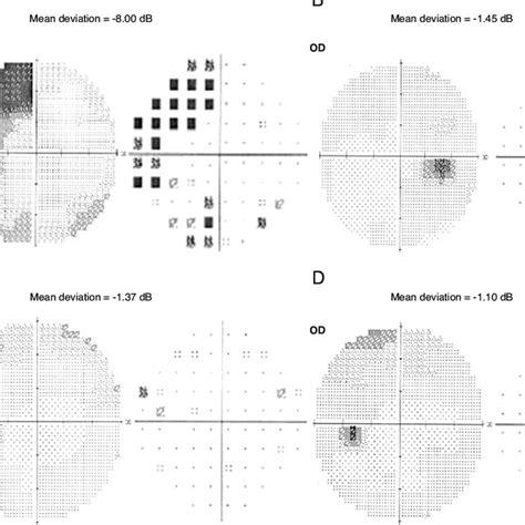 Patterns Of Binocular Visual Field Defects In Patients With Pituitary