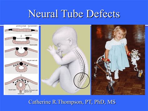 Fetal Neural Tube Defects