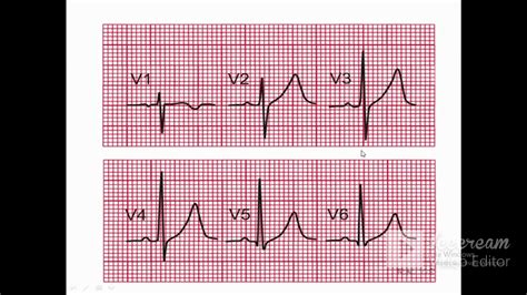 Right Ventricular Hypertrophy Ecg Criteria And Xray Finding Youtube
