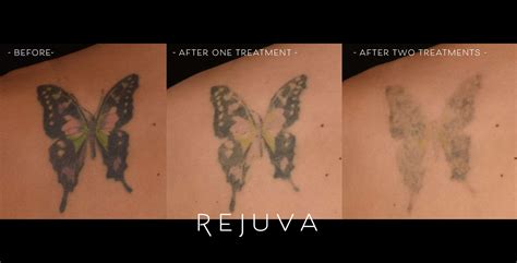 Tattoo Removal Rejuva Medical Aesthetics