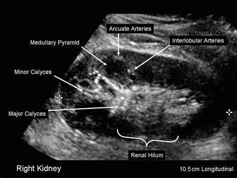 What does renal hilum mean? Renal Duplex Scanning | Thoracic Key