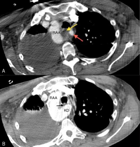 Axial Contrast Enhanced Chest Ct Showing A Right Sided Aortic Arch