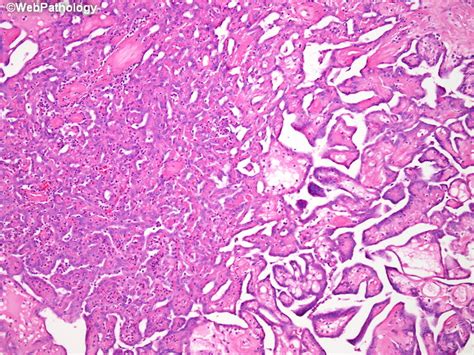Less than 5% of malignant peritoneal mesotheliomas are localised primarily in the tunica vaginalis testis. Webpathology.com: A Collection of Surgical Pathology Images