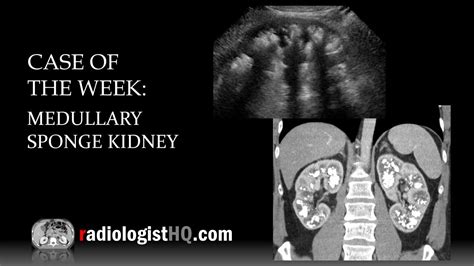 Case Of The Week Medullary Sponge Kidney Ultrasound And Ct Youtube